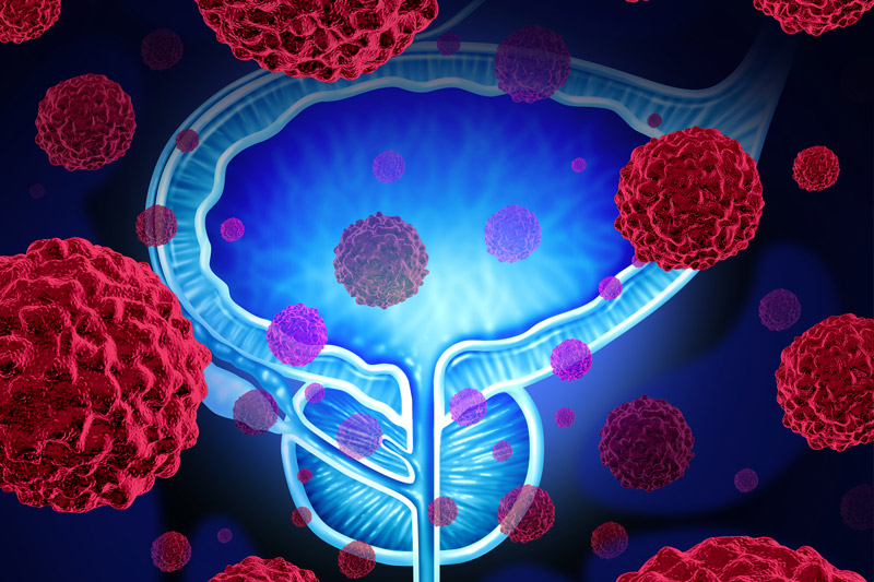 Cancer Cells Attacking Prostate