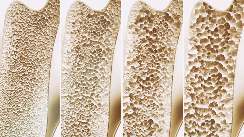 Are Osteoporosis Medications Safe to Take?