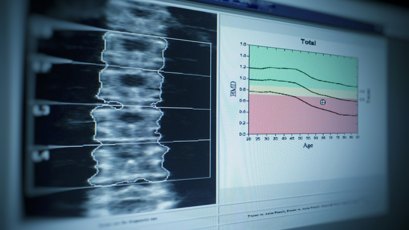 Vertebrae on DEXA Scan Image