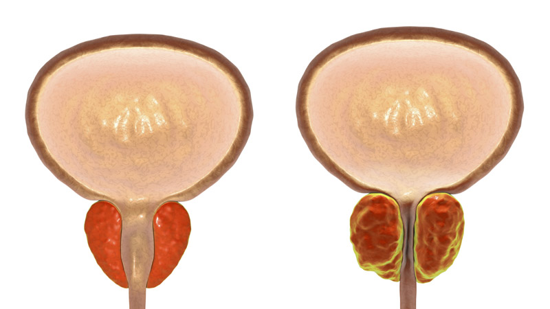 Normal vs. Enlarged Prostate